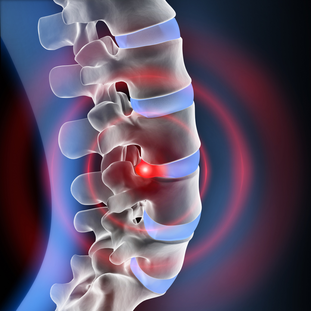 Degenerative Disc Disease Shore Spine & Pain